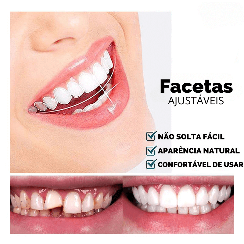 Facetas Dentárias Universal - Smile