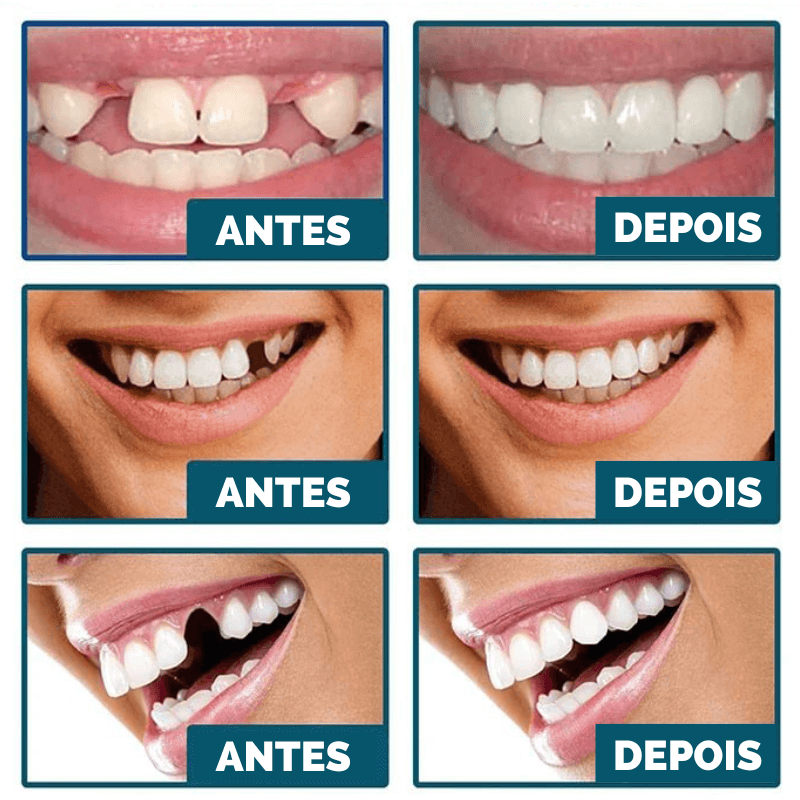 Facetas Dentárias Universal - Smile