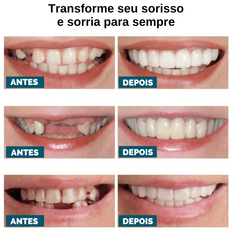 Facetas Dentárias Universal - Smile